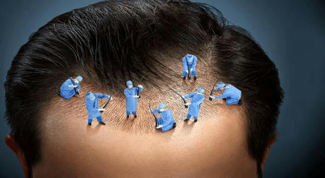 How Much Does a Hair Transplant Really Cost ? The Truth Revealed